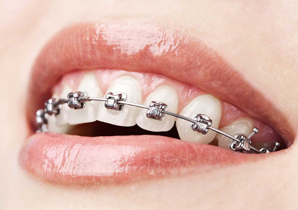 Closeup of dental braces
